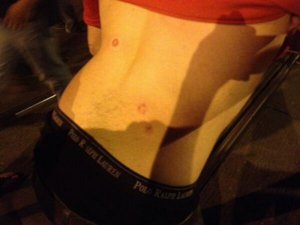 PHOTO: Man in neck brace shot 4 times in back with pepper balls during riot on University Boulevard.