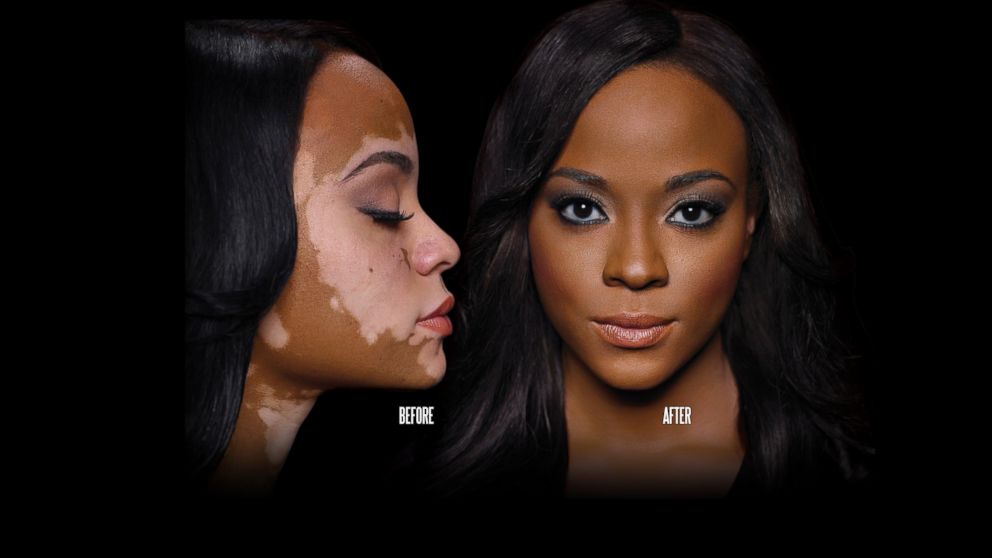 Makeup helps cover up this woman's vitiligo.