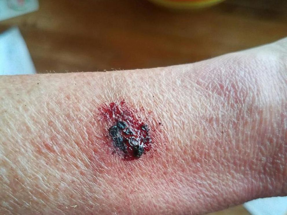 PHOTO: Dina Mitchell of Wisconsin shows her arm after suffering from second-degree burns.