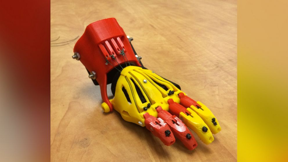 PHOTO: The Siena College e-NABLE chapter designed an "Iron Man" prosthetic hand, pictured here, for five-year-old Jack Carder in Columbus, Ohio. 