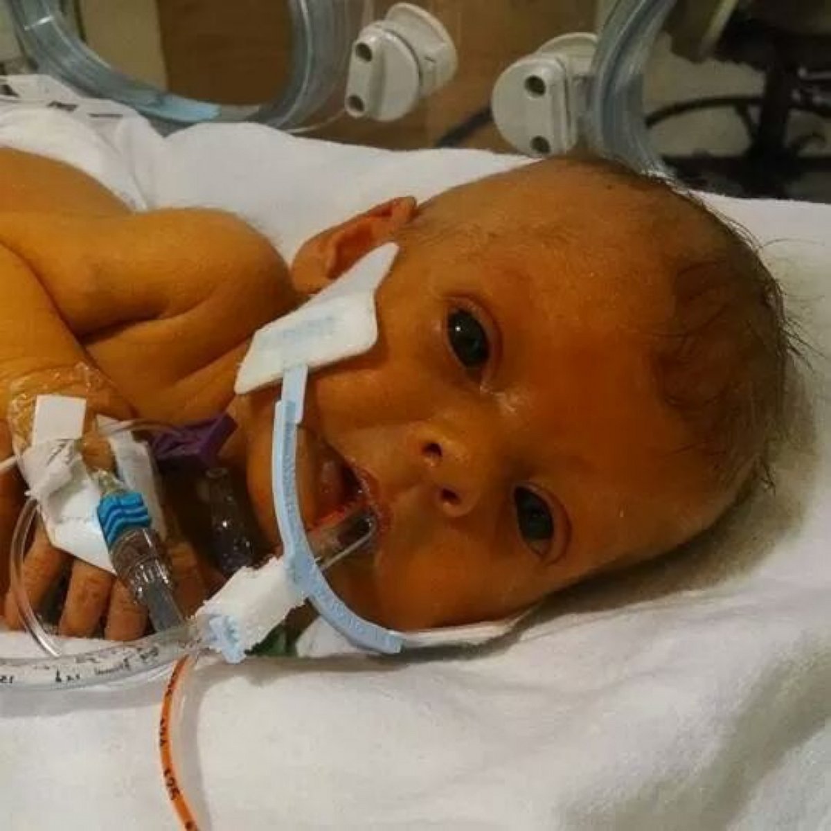 PHOTO: Nathan Steffel reached out to Reddit for help removing the tubes from a photo of his daughter.