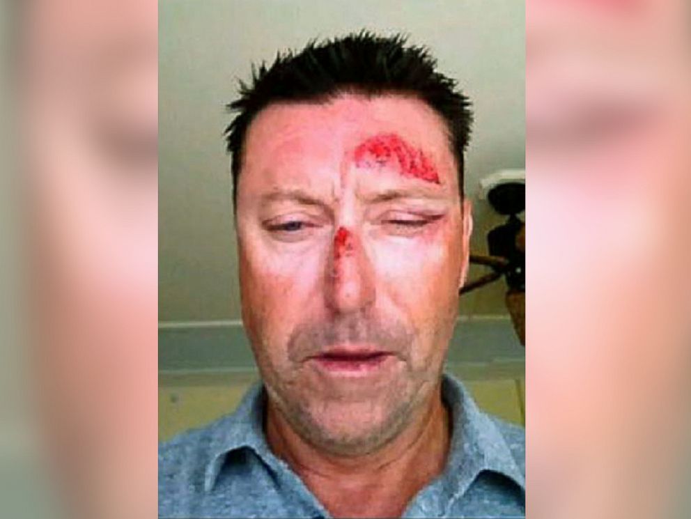 PHOTO: Australian golfer Robert Allenby says he was robbed, beaten and dumped in a park, leaving him with cuts and a deep scrape on his forehead.