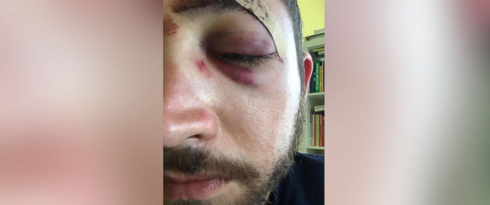 PHOTO: Mario Licato, 26, says he was punched and 'knocked out, cold' by a man who told him he did it because he looked like actor Shia LaBeouf.