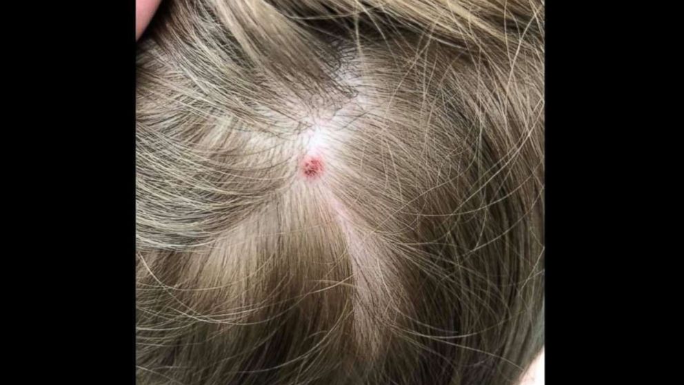 Tick Bite On Scalp