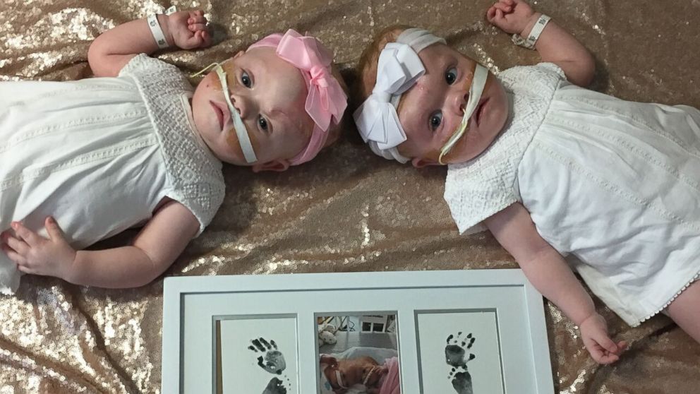 VIDEO: Family shares update on formerly conjoined twins following seperation surgery