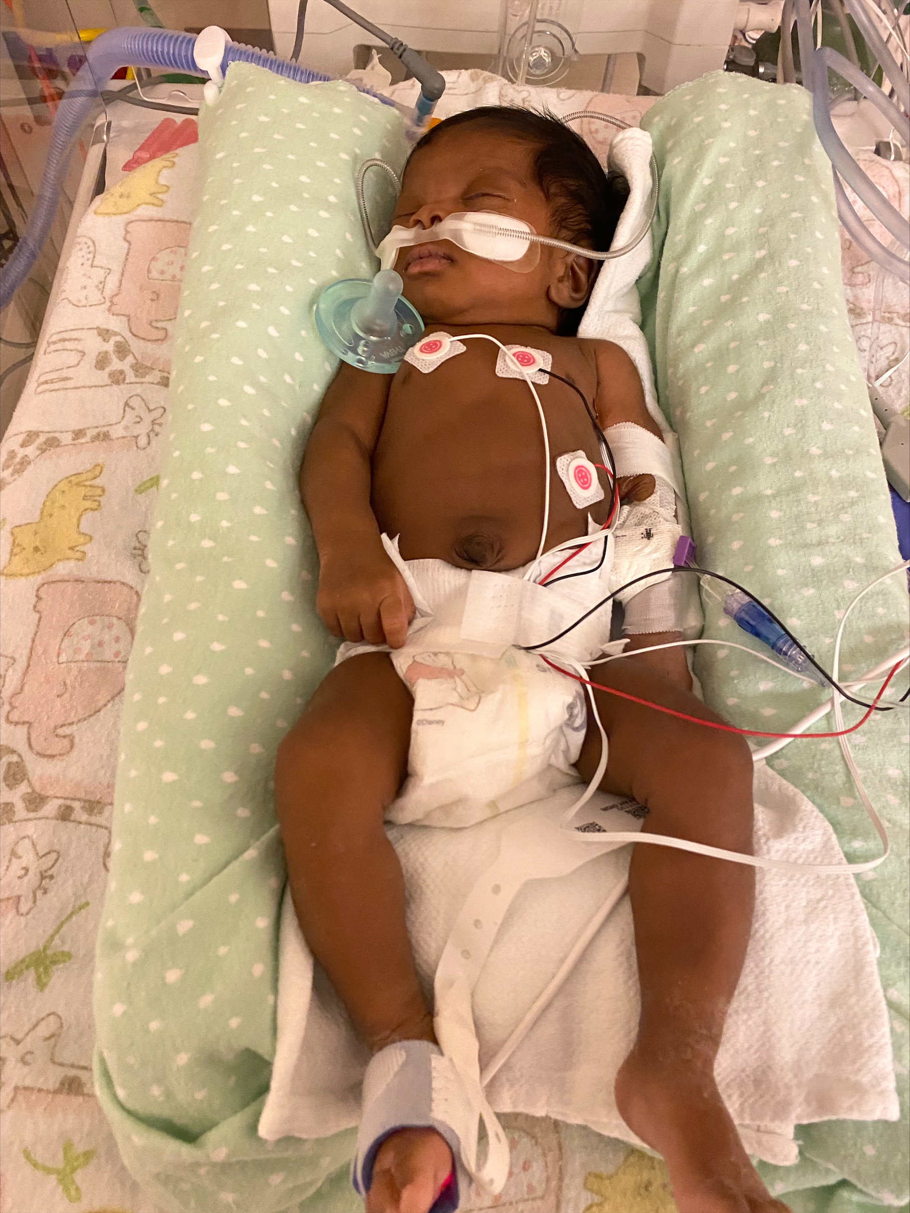 PHOTO: One-month-old Kamiya Johnson was diagnosed with Respiratory Syncytial Virus (RSV) this month.