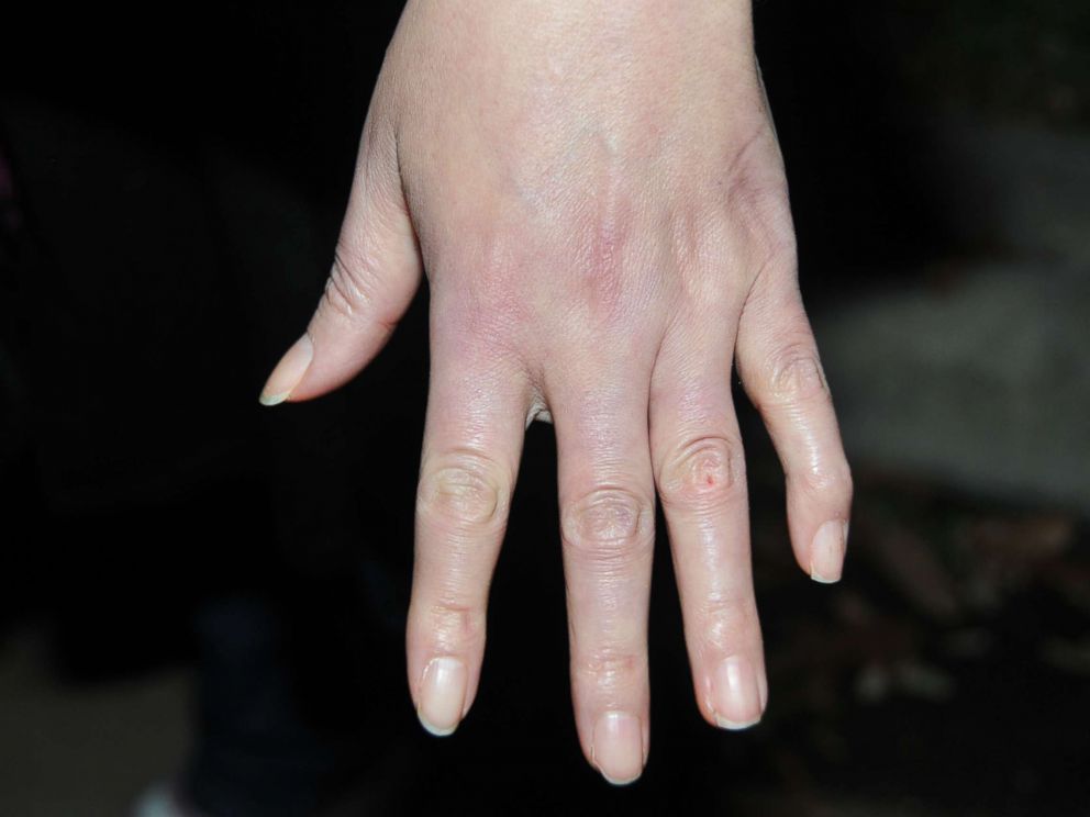 PHOTO: Sandra Melgars hands were a subject of debate -- if she was guilty, why were her hands clean from blood and her nails undamaged from the violence?