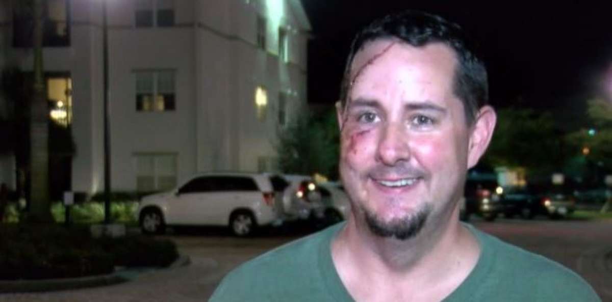 Andy Meunier has an ugly souvenir on his face after tangling with a bear outside his home in Naples, Florida. 