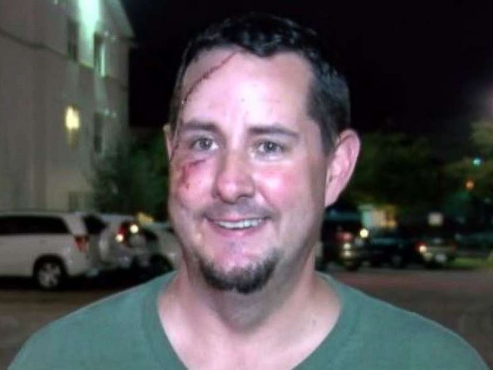 Andy Meunier has an ugly souvenir on his face after tangling with a bear outside his home in Naples, Florida.