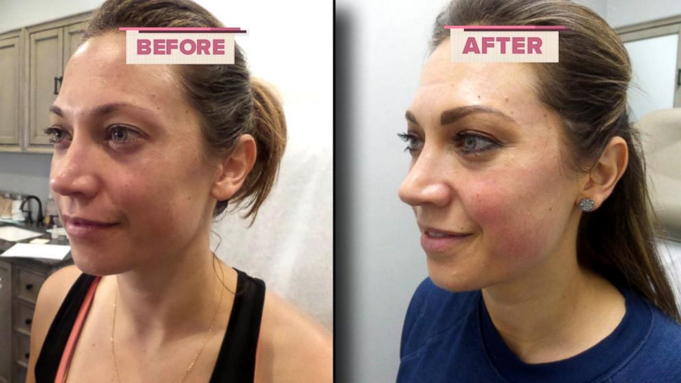 PHOTO: ABC News chief meteorologis Ginger Zee opens up about her melasma journey.