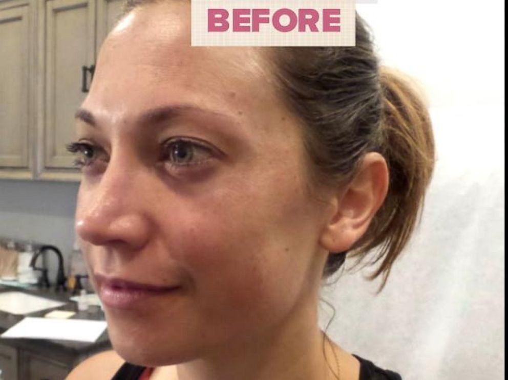 PHOTO: ABC News chief meteorologis Ginger Zee opens up about her melasma journey.