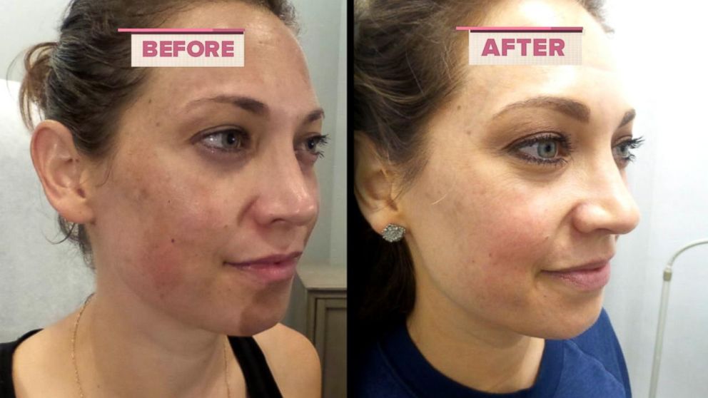 PHOTO: ABC News chief meteorologis Ginger Zee opens up about her melasma journey.