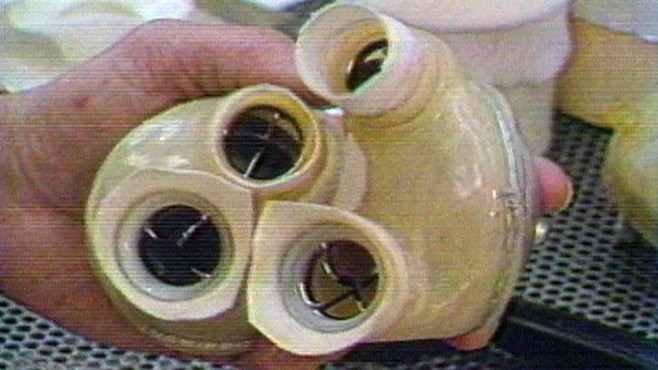 first artificial heart transplant 1982