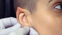 Ear Pointing Surgery Elf Ears Or Mr Spock ABC News   Abc Elf Ears Dm 110407 Wl 