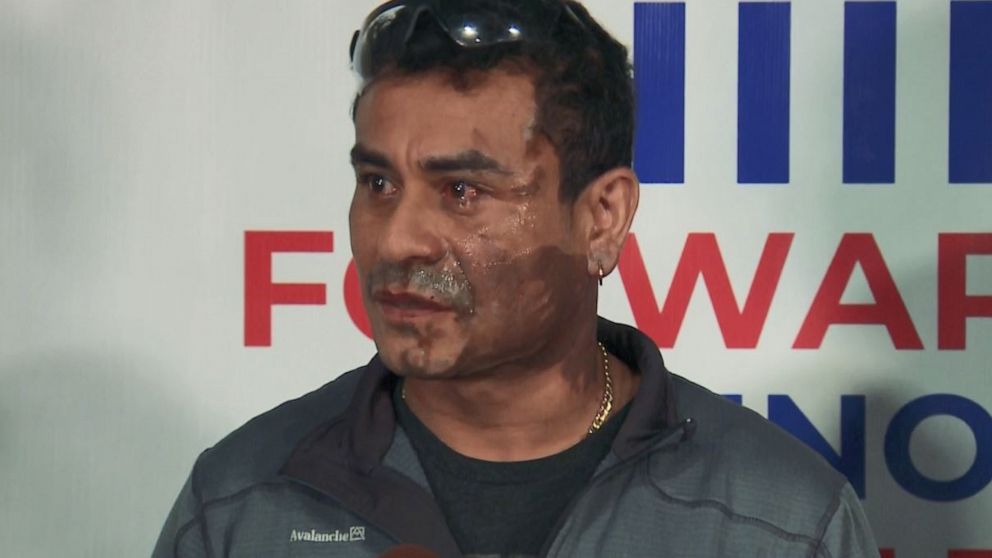 PHOTO: Mahud Villalaz, 42, a Milwaukee, Wis., native, says he had battery acid thrown in his face after an argument with a stranger who told him to "get out of this country."