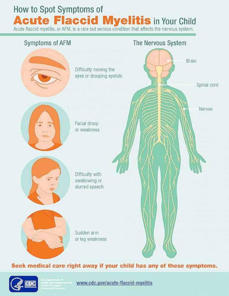 PHOTO: An infographic distributed by the Centers for Disease Control and Prevention on "How to Spot Symptoms of Acute Flaccid Myelitis in Your Child." 