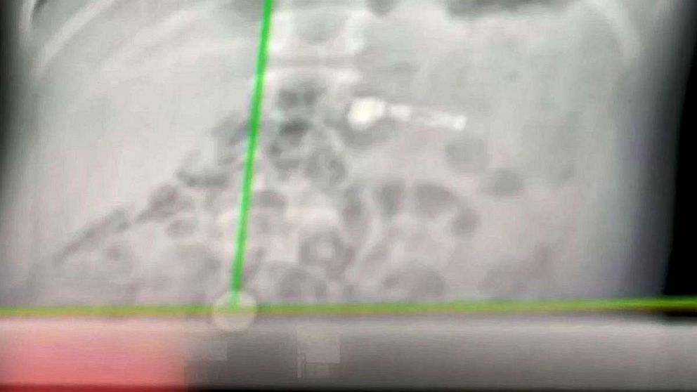 PHOTO: An x-ray revealed the AirPod accidentally swallowed by Kiara Stroud's son which he had received as a Christmas present.