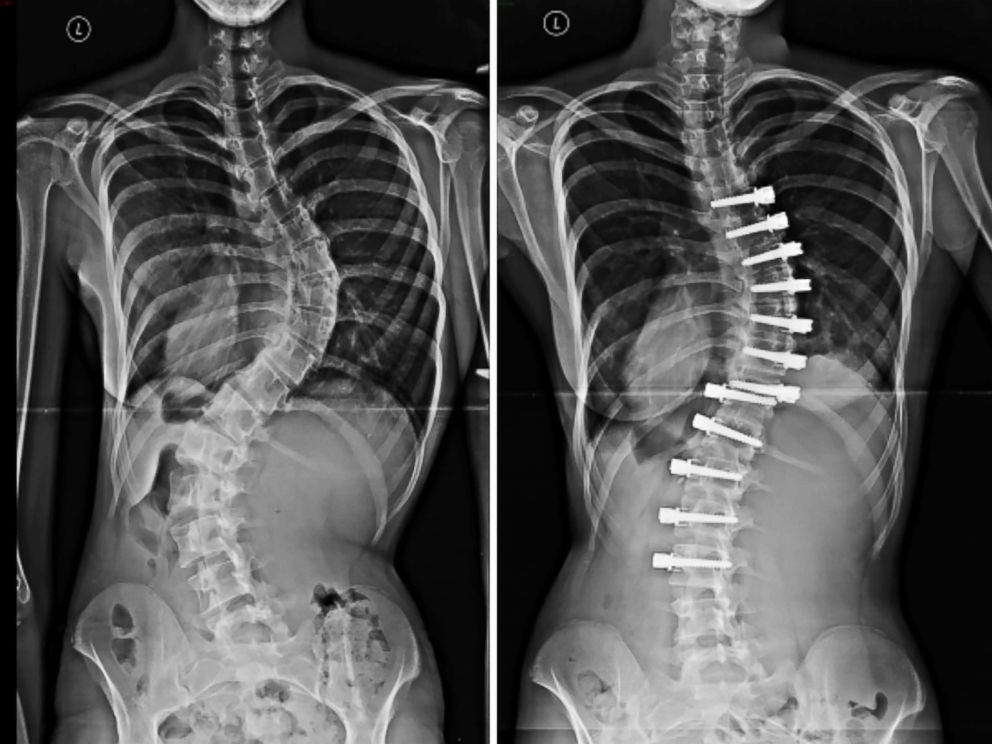 PHOTO: An x-ray of Anastasia Machenko's spine prior to undergoing a tethering treatment for scoliosis.|An x-ray of Anastasia Machenko's spine after undergoing a tethering treatment for scoliosis.