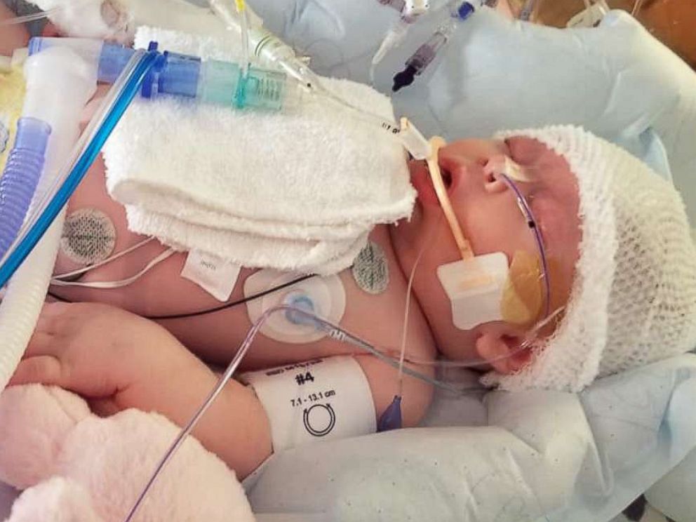 PHOTO: Seven-week-old McKenna Hovenga is pictured in the hospital in Rochester, Minn., after she was accidentally struck in the head by a ball at a recreational softball game in Iowa.