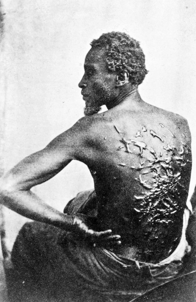 PHOTO: Gordon, also known as "Whipped Peter", a formerly enslaved man, shows his scarred back at a medical examination, Baton Rouge, La., April 2, 1863.
