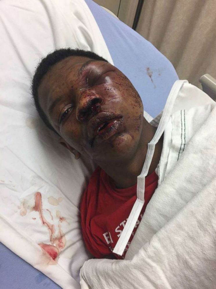 PHOTO: Ulysses Wilkerson, 17-year-old, lies in a hospital bed following his arrest by police officers in Troy, Ala. His mother Angela Williams posted the photos claiming her son was a victim of police brutality. 