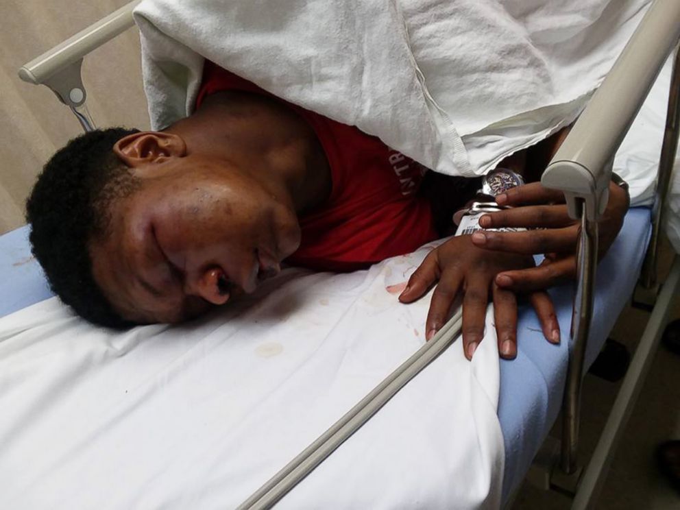 PHOTO: Ulysses Wilkerson, 17-year-old, lies in a hospital bed following his arrest by police officers in Troy, Ala. His mother Angela Williams posted the photos claiming her son was a victim of police brutality. 