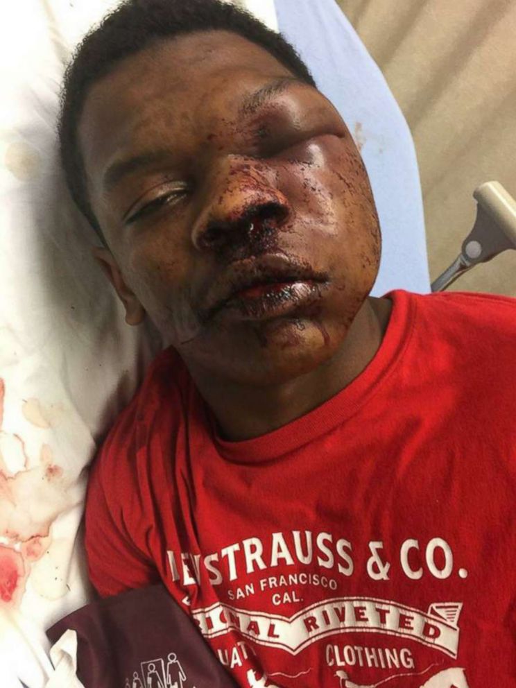 PHOTO: Ulysses Wilkerson, 17-year-old, lies in a hospital bed following his arrest by police officers in Troy, Ala. His mother Angela Williams posted the photos claiming her son was a victim of police brutality. 