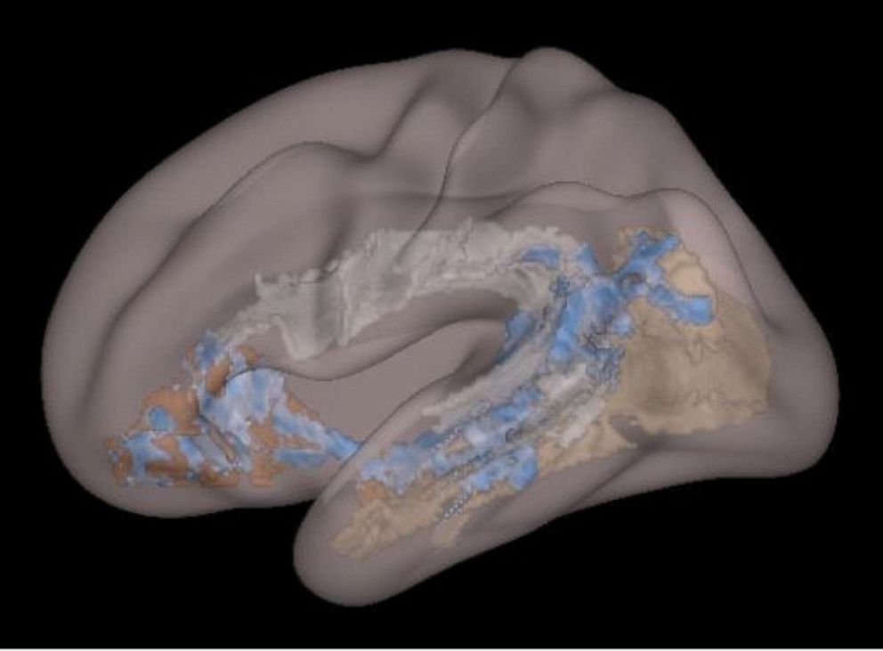 PHOTO: This lateral brain image shows white matter tracts with lower structural integrity associated with more screen time in these children. Affected areas are in blue, and ranged from 16 percent to 55 percent in three main tracts of interest.