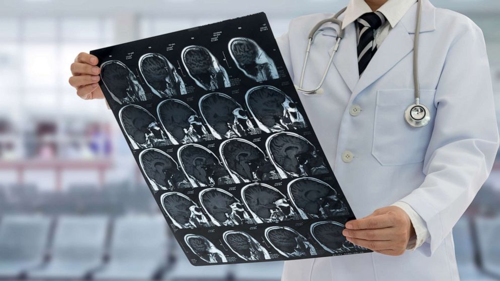 PHOTO: A doctor reviews brain scans in this stock photo.