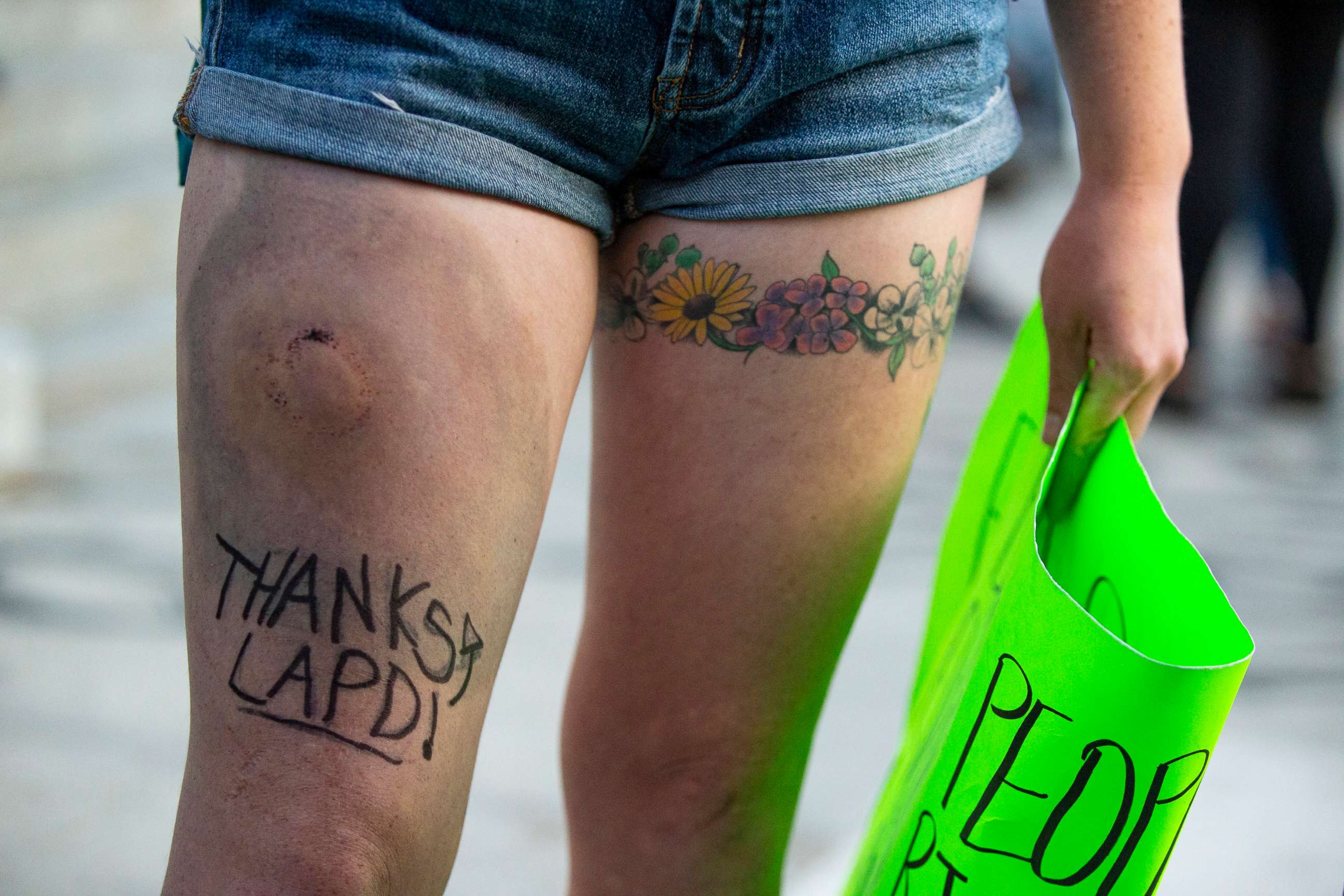 PHOTO: Demonstrator Colleen Jane, draws attention to a hematoma she says was inflicted by a police officer's rubber bullet, by writing "Thanks LAPD!" on her right leg during a "Black Lives Matter" rally, June 6, 2020, outside Los Angeles City Hall.