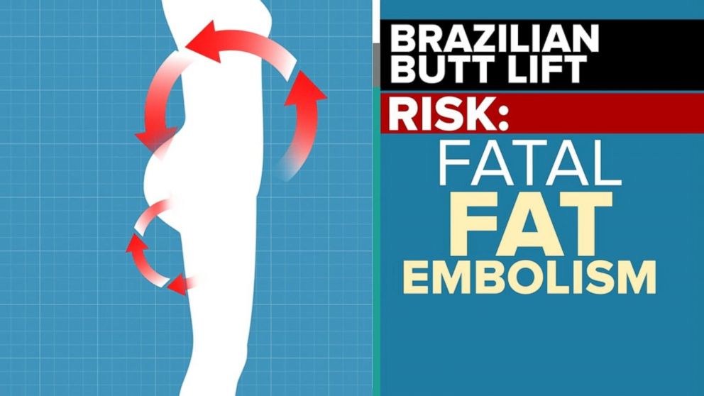 Plastic Surgeons Group Issues New Warning Over Brazilian Butt Lift