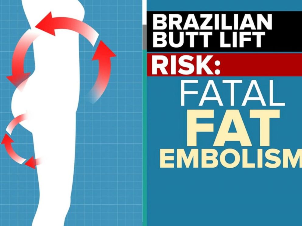 PHOTO: As many as one in 3,000 people who undergo the Brazilian butt lift die, according to a new warning.