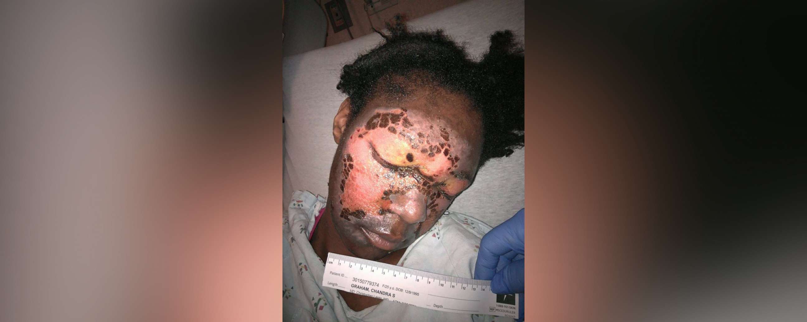 PHOTO: Chandra Graham alleges she suffered burns on her face at her former jail after a liquid mixed with urine and feces splashed onto her face.