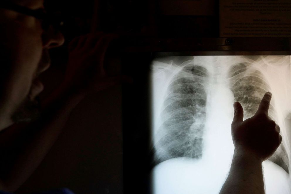 PHOTO: Radiology technician Mark Davis looks at the chest x-ray of retired coal miner James Marcum, who has complicated black lung disease, at Stone Mountain Health Services in St. Charles, Va., May 18, 2018.