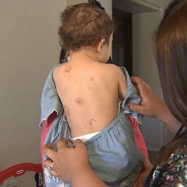 1-year-old girl bitten 'multiple times' at day care, school says