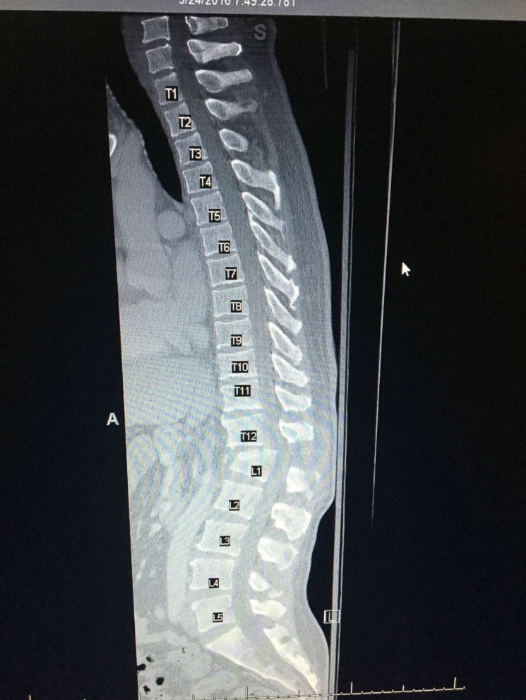PHOTO: Dean Otto's spine was torn in two and dislocated, his doctor said. He also had no movement in his legs. "The odds were stacked against him," his doctor said.