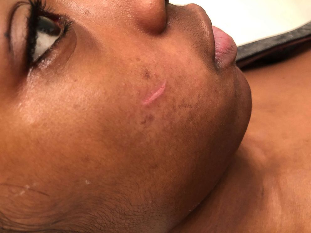 A cut is visible on the face of a teen who was filmed in a confrontation with Chicago police officers at her school on Tuesday, Jan. 29, 2019. The 16-year-old is facing two felony charges.