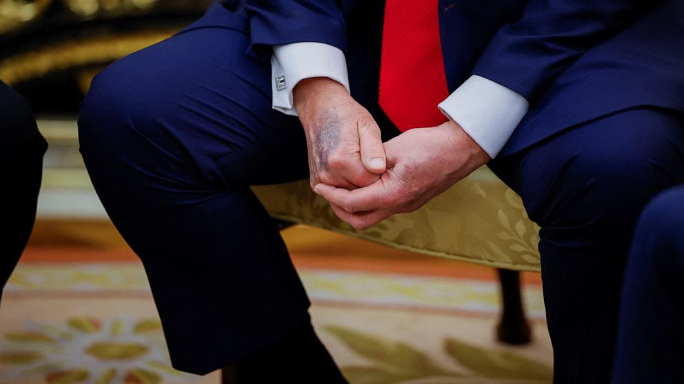 PHOTO: A mark on a hand of U.S. President Donald Trump is seen during a meeting with South Korean President Lee Jae Myung at the Oval Office, at the White House, in Washington, August 25, 2025.