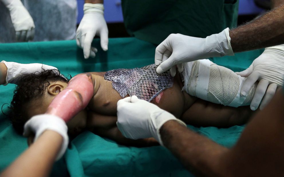PHOTO: Doctors wrap a child's burnt skin with sterilized tilapia fish skin at Dr. Jose Frota Institute in the northeastern coastal city of Fortaleza, Brazil, May 3, 2017. 