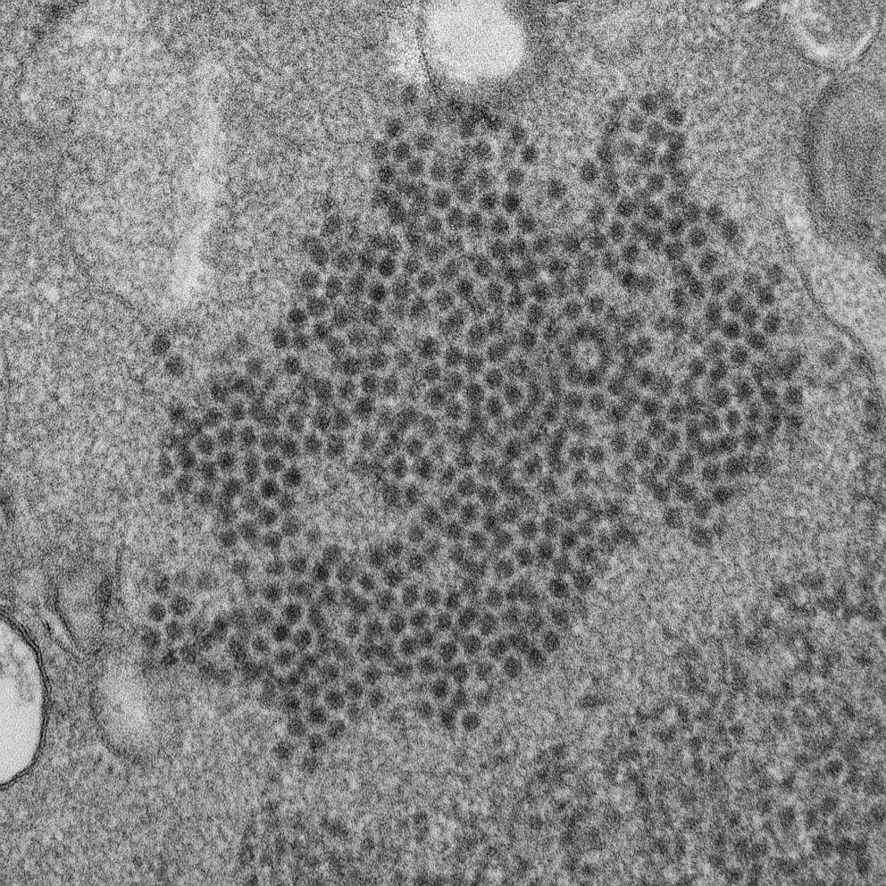 PHOTO: This 2014 file electron microscope image made available by the CDC and Prevention shows numerous, spheroid-shaped enterovirus-D68 (EV-D68) virions.