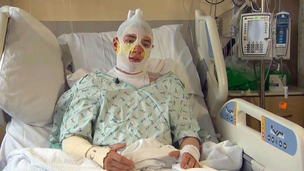 Family of 20-year-old burn victim says he is 'staying positive' while in  the hospital