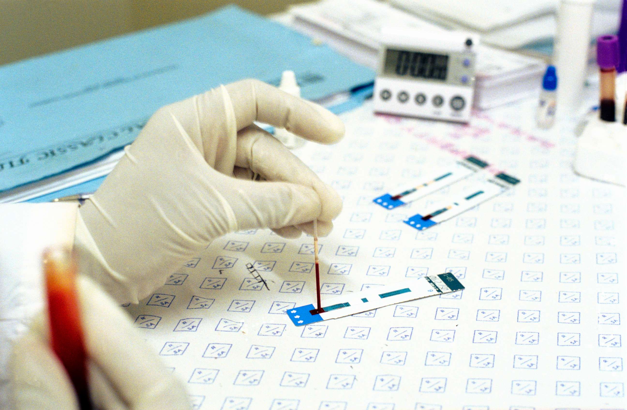 PHOTO: A person tests blood in this stock photo.