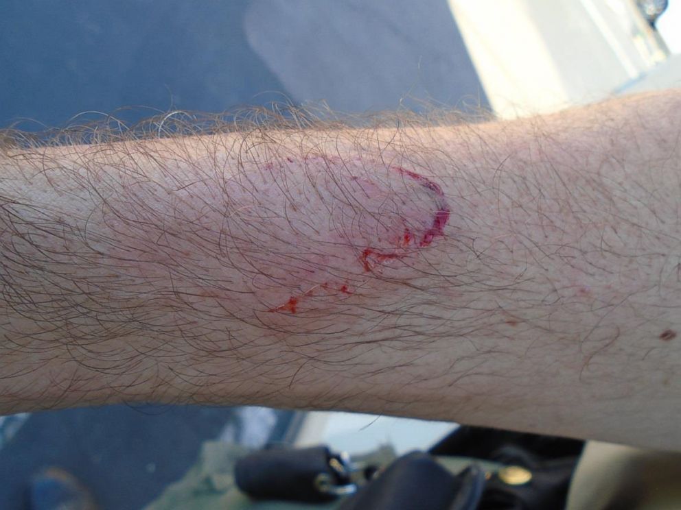 PHOTO: A photo released by the San Diego County Sheriff's Department shows a bite mark on the arm of Deputy Jeremy Banks that the department says he received while trying to take a juvenile into custody on June 13, 2015.