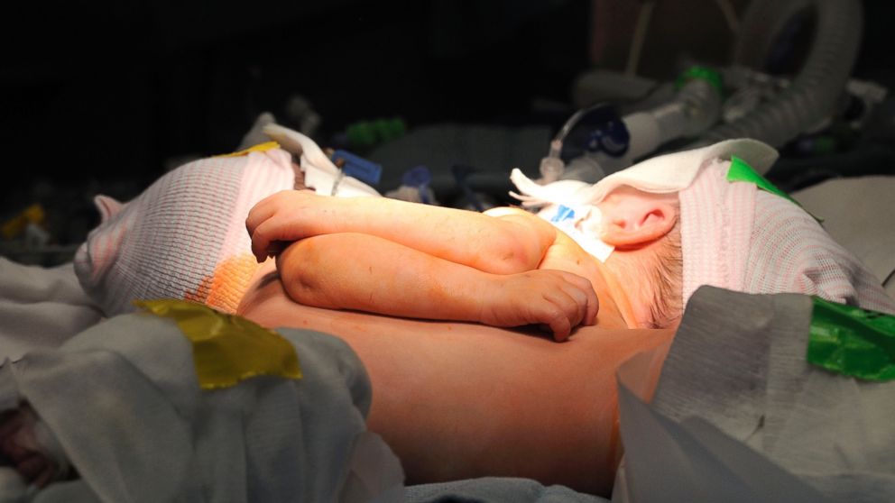 Conjoined twin girls were separated on Nov. 11 at Kosair Children's Hospital in Louisville.