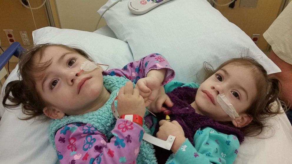 Conjoined Twins Before And After Surgery