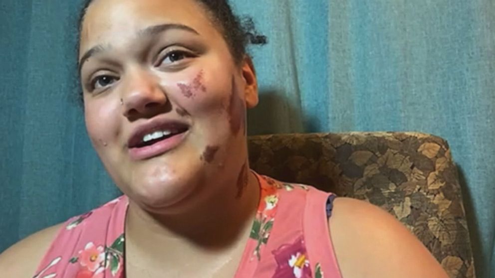 VIDEO: Biracial woman claims attack by 4 white men