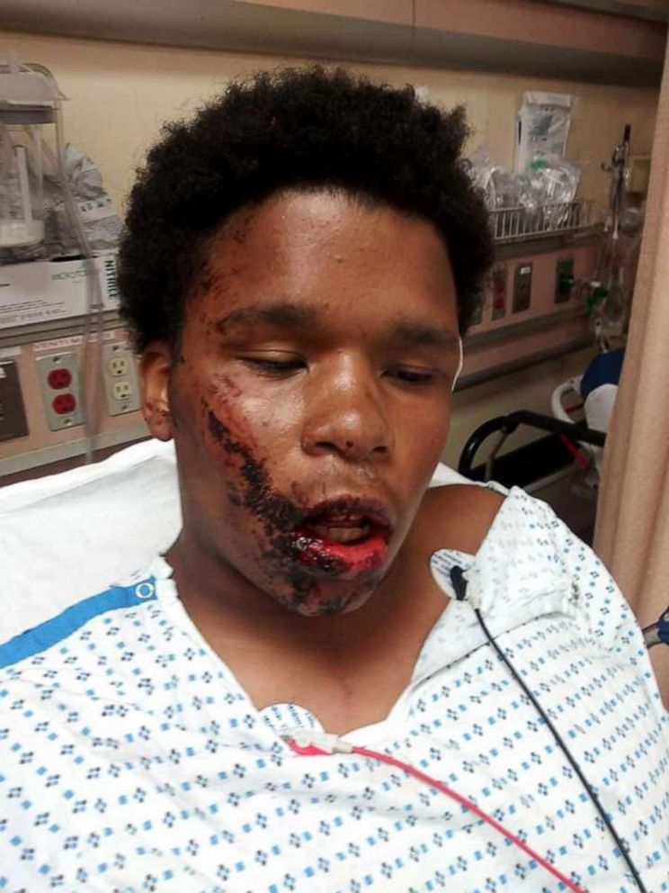 PHOTO: Jahmel Leach, 16, suffered injuries to his face allegedly by NYPD during an arrest for allegations of arson on June 1.