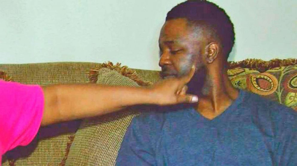 PHOTO: In this May 18, 2018 photograph taken from news video, James Barnett of Laurel, Miss., shows the injuries he allegedly sustained after two Laurel police officers pursued and arrested him after he turned around from a police checkpoint May 16.