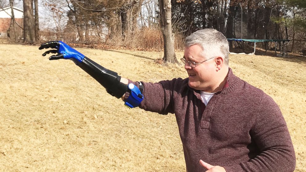 Teen builds baseball-throwing prosthetic arm for father injured