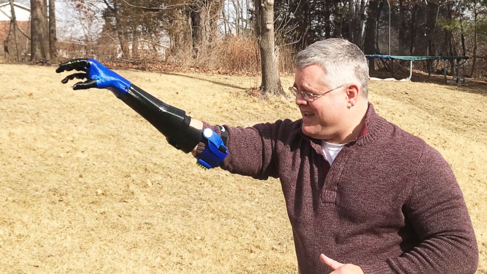 Teen builds baseball-throwing prosthetic arm for father injured
